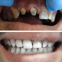 carillas y blanqueamiento